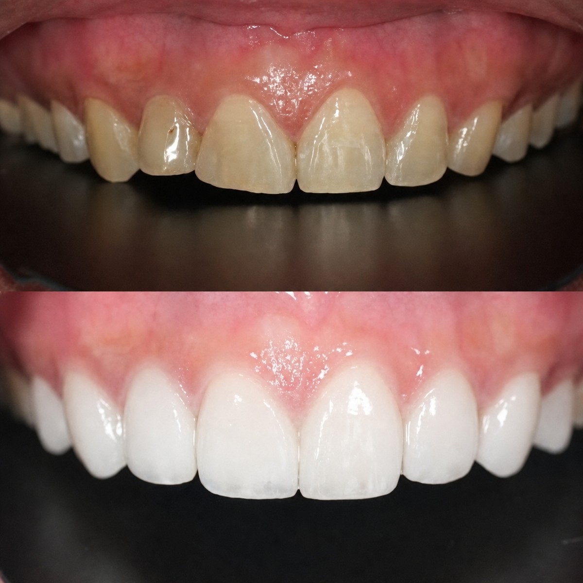 نتيجة قبل وبعد الفينير في Dentist at home Clinic، تشونبوري – أسنان بيضاء ومتساوية