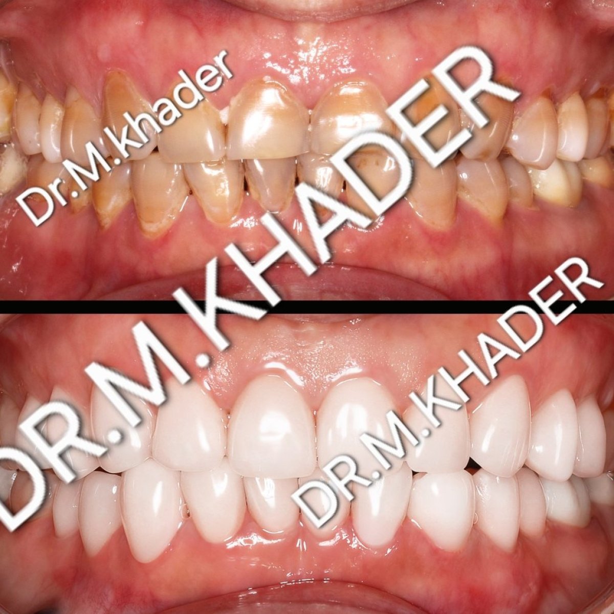 Resultado antes y después de carillas en Wuhan Yiya Simei Dental Hospital, transformación de sonrisa