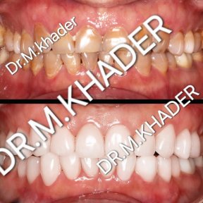 before-after photo installation-of-a-veneer