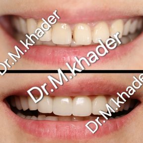 before-after photo emax-veneers