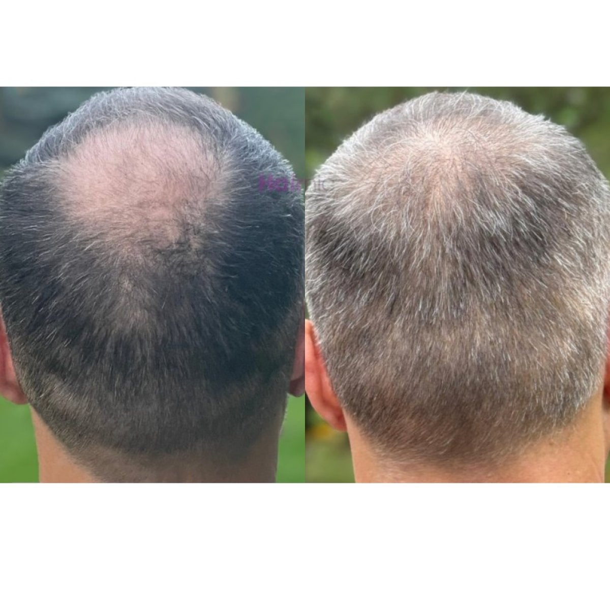 قبل وبعد زراعة الشعر FUE في Hair Clinic PRIVÉ، استعادة شعر التاج بوضوح