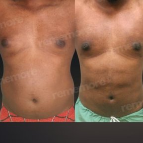 before-after photo tummy-tuck-and-liposuction