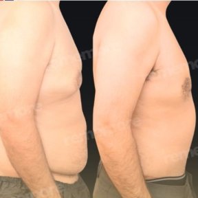 before-after photo tummy-tuck-and-liposuction