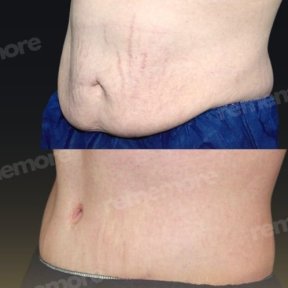 before-after photo tummy-tuck-and-liposuction