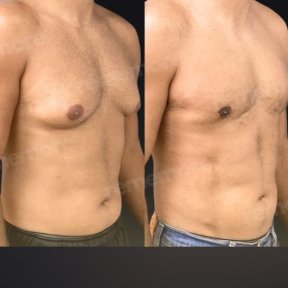 before-after photo tummy-tuck-and-liposuction