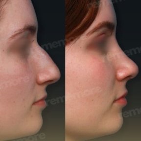 before-after photo ethnic-rhinoplasty