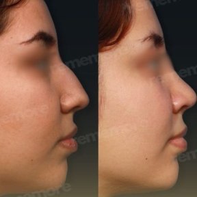 before-after photo ethnic-rhinoplasty