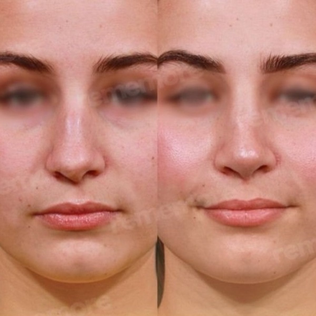 Resultados de rinoplastia étnica antes y después en Memorial Bahçelievler Hospital, remodelación nasal