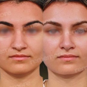 before-after photo ethnic-rhinoplasty