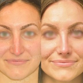 before-after photo ethnic-rhinoplasty