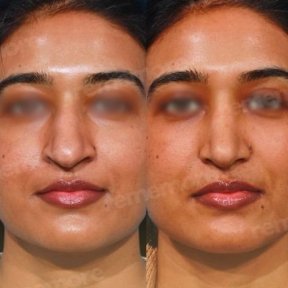 before-after photo ethnic-rhinoplasty
