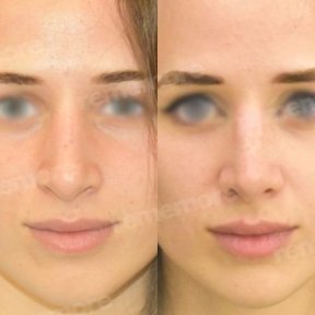 before-after photo ethnic-rhinoplasty