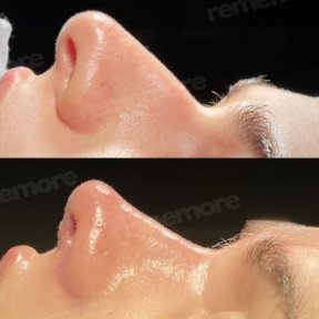 before-after photo ethnic-rhinoplasty