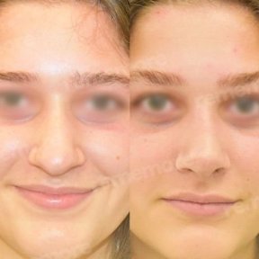 before-after photo ethnic-rhinoplasty