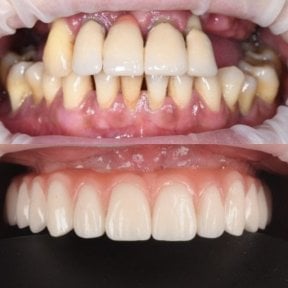 before-after photo all-on-4-dental-implants