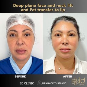 before-after photo tightening-of-facial-skin-facelift