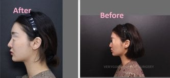 نتائج حقن الدهون قبل وبعد في VG Plastic Surgery – تحسين ملامح الوجه بشكل واضح