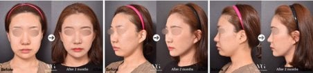 نتائج حقن الدهون في VG Plastic Surgery – زيادة حجم الوجه بعد شهرين