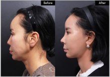 نتائج تحديد ملامح الوجه بحقن الدهون قبل وبعد في VG Plastic Surgery