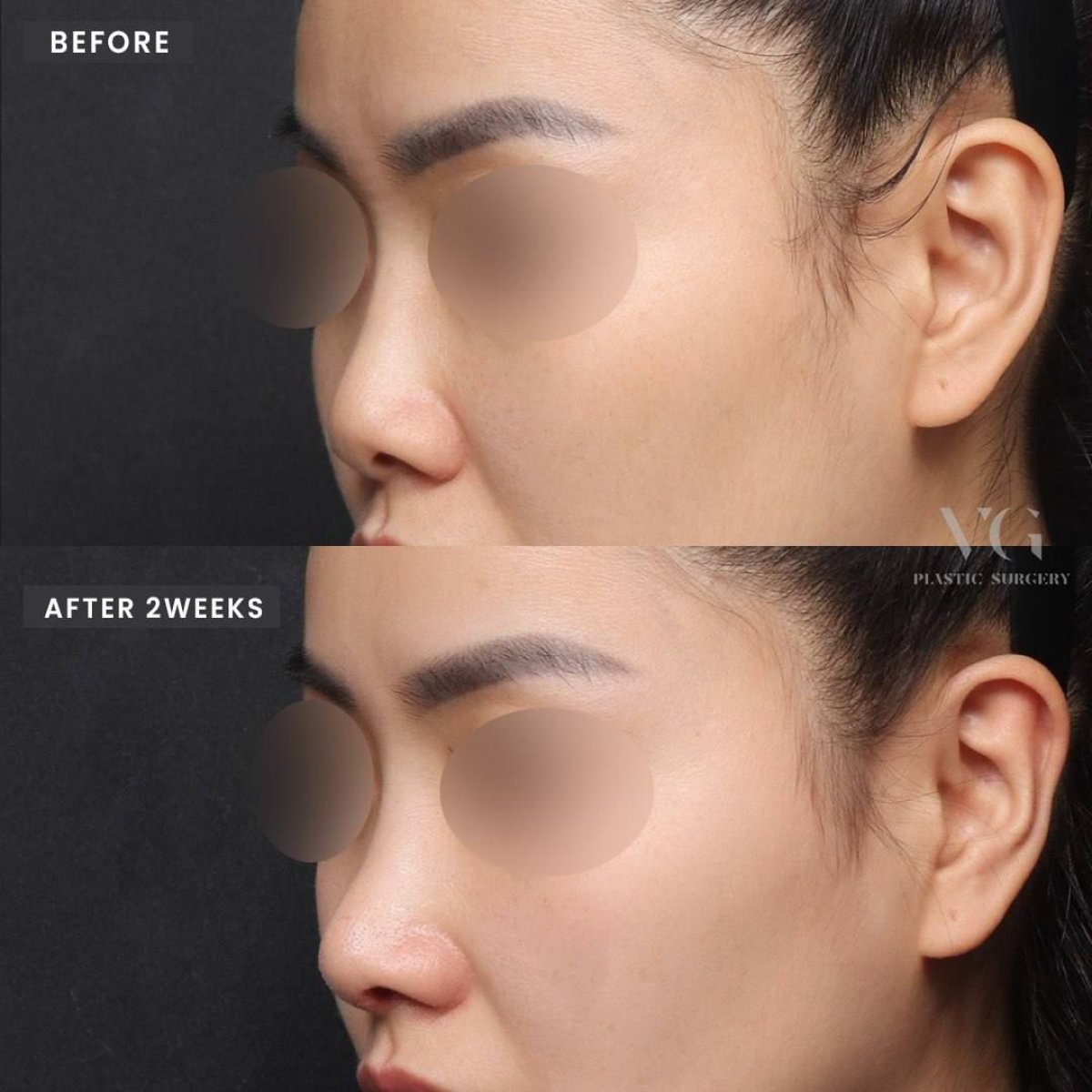 Resultado de rinoplastia antes y después en VG Plastic Surgery, cambio visible tras 2 semanas