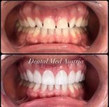 Before and after dental veneers at Dental Med Austria, smile makeover with natural results