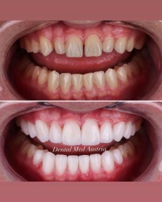 Before and after dental veneers at Dental Med Austria & Elixence, smile makeover result
