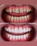 Before and after dental veneers at Dental Med Austria & Elixence, smile makeover result