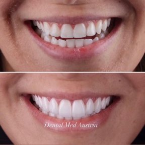 Before and after dental veneers at Dental Med Austria & Elixence, smile makeover result