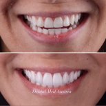 Before and after dental veneers at Dental Med Austria & Elixence, smile makeover result