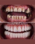 Before and after All-on-6 dental implants result at Dental Med Austria & Elixence, smile restoration