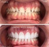 Before and after dental veneers at Dental Med Austria & Elixence, smile makeover results