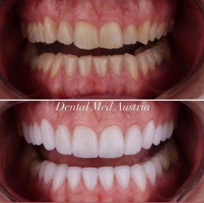 Before and after dental veneers at Dental Med Austria & Elixence, smile makeover results