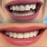 Before and after dental veneers at Dental Med Austria & Elixence, smile makeover results