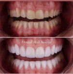 Before and after dental veneers at Dental Med Austria & Elixence, smile makeover results