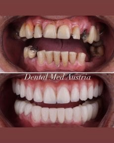 نتيجة قبل وبعد زراعة الأسنان All-on-6 في Dental Med Austria & Elixence، استعادة الابتسامة