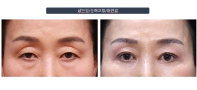 Efekty blefaroplastyki dolnych powiek przed i po w klinice Returning Plastic Surgery