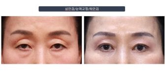 Efekty blefaroplastyki dolnych powiek przed i po w klinice Returning Plastic Surgery
