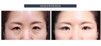 Efekty blefaroplastyki dolnych powiek przed i po w klinice Returning Plastic Surgery