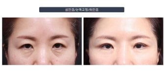 Efekty blefaroplastyki dolnych powiek przed i po w klinice Returning Plastic Surgery