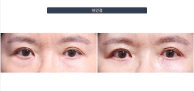 Efekty blefaroplastyki dolnych powiek przed i po w klinice Returning Plastic Surgery