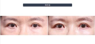 Efekty blefaroplastyki dolnych powiek przed i po w klinice Returning Plastic Surgery