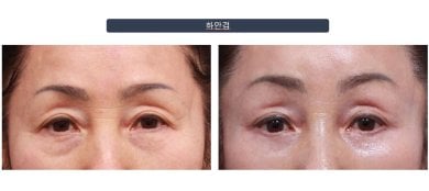 Efekty plastyki dolnych powiek przed i po w klinice Returning Plastic Surgery