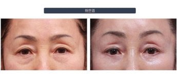 Efekty plastyki dolnych powiek przed i po w klinice Returning Plastic Surgery