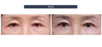 Efekty plastyki dolnych powiek przed i po w Returning Plastic Surgery