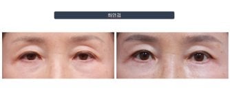 Efekty plastyki dolnych powiek przed i po w Returning Plastic Surgery