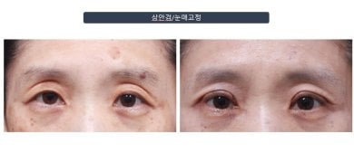 Efekty blefaroplastyki dolnych powiek przed i po w klinice Returning Plastic Surgery