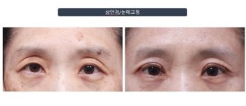 Efekty blefaroplastyki dolnych powiek przed i po w klinice Returning Plastic Surgery