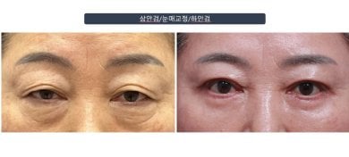 Efekty przed i po plastyce dolnych powiek w klinice Returning Plastic Surgery