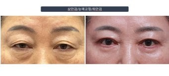 Efekty przed i po plastyce dolnych powiek w klinice Returning Plastic Surgery