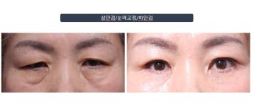 Efekty plastyki dolnych powiek przed i po w klinice Returning Plastic Surgery
